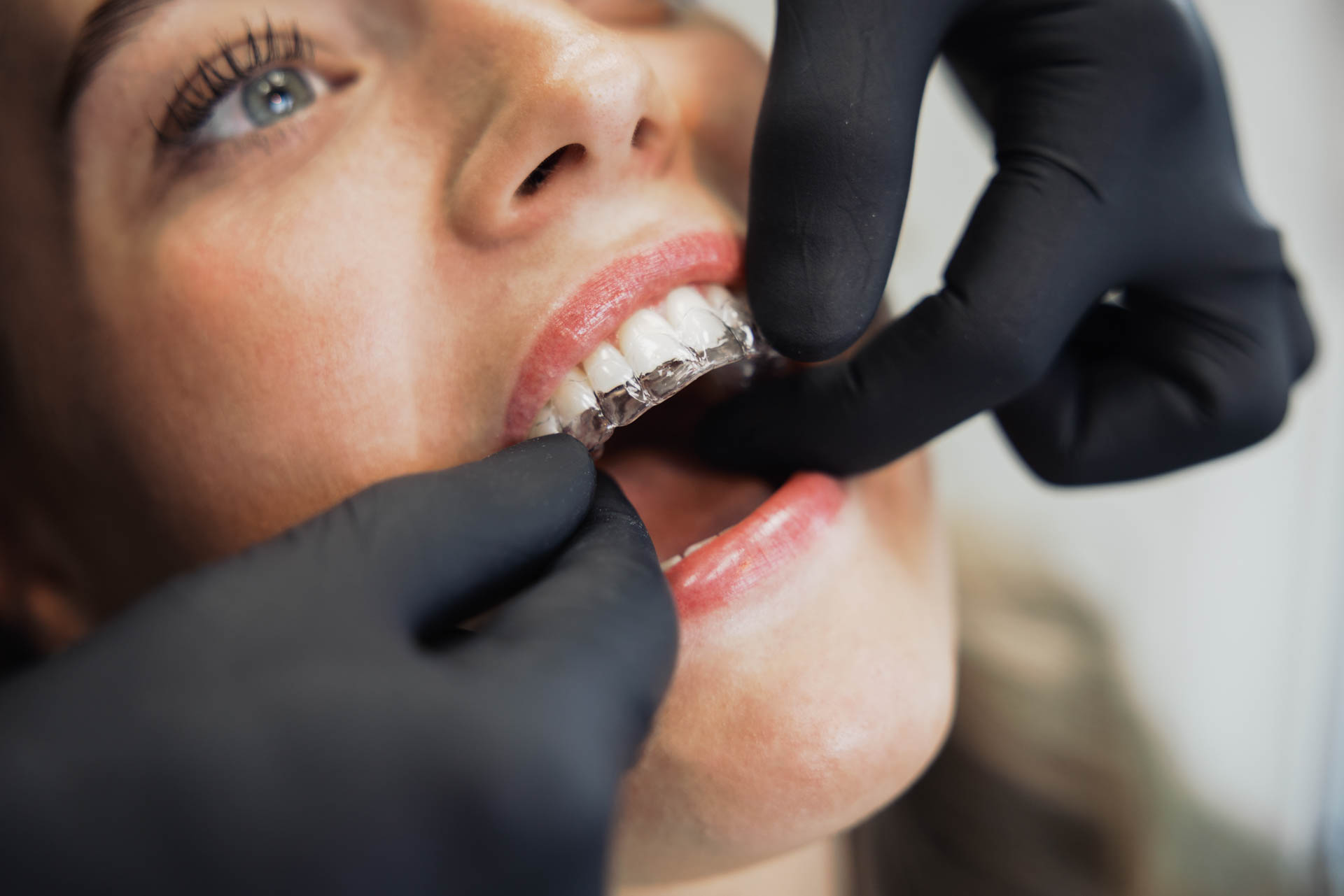Anprobe eines Aligners in der Stadtwald Klinik